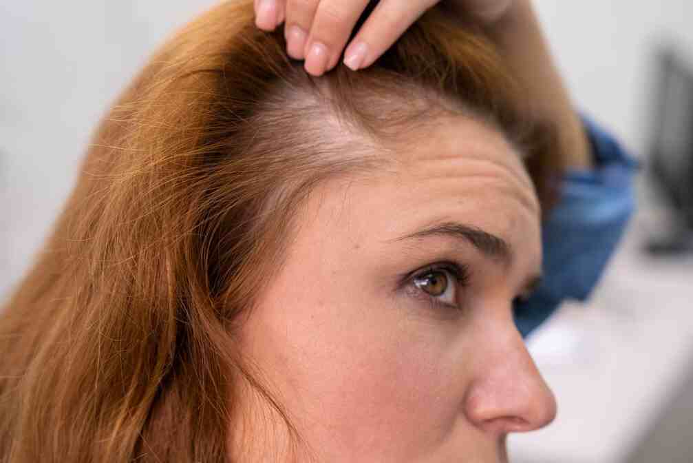 8 Simple Ways To Treat Hair Loss At The Temples